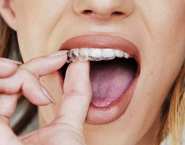 A person is placing a clear dental aligner over their upper teeth with their mouth open and fingers guiding the aligner, demonstrating one of the essential Cosmetic Dentistry Tips for achieving a straighter, more confident smile.