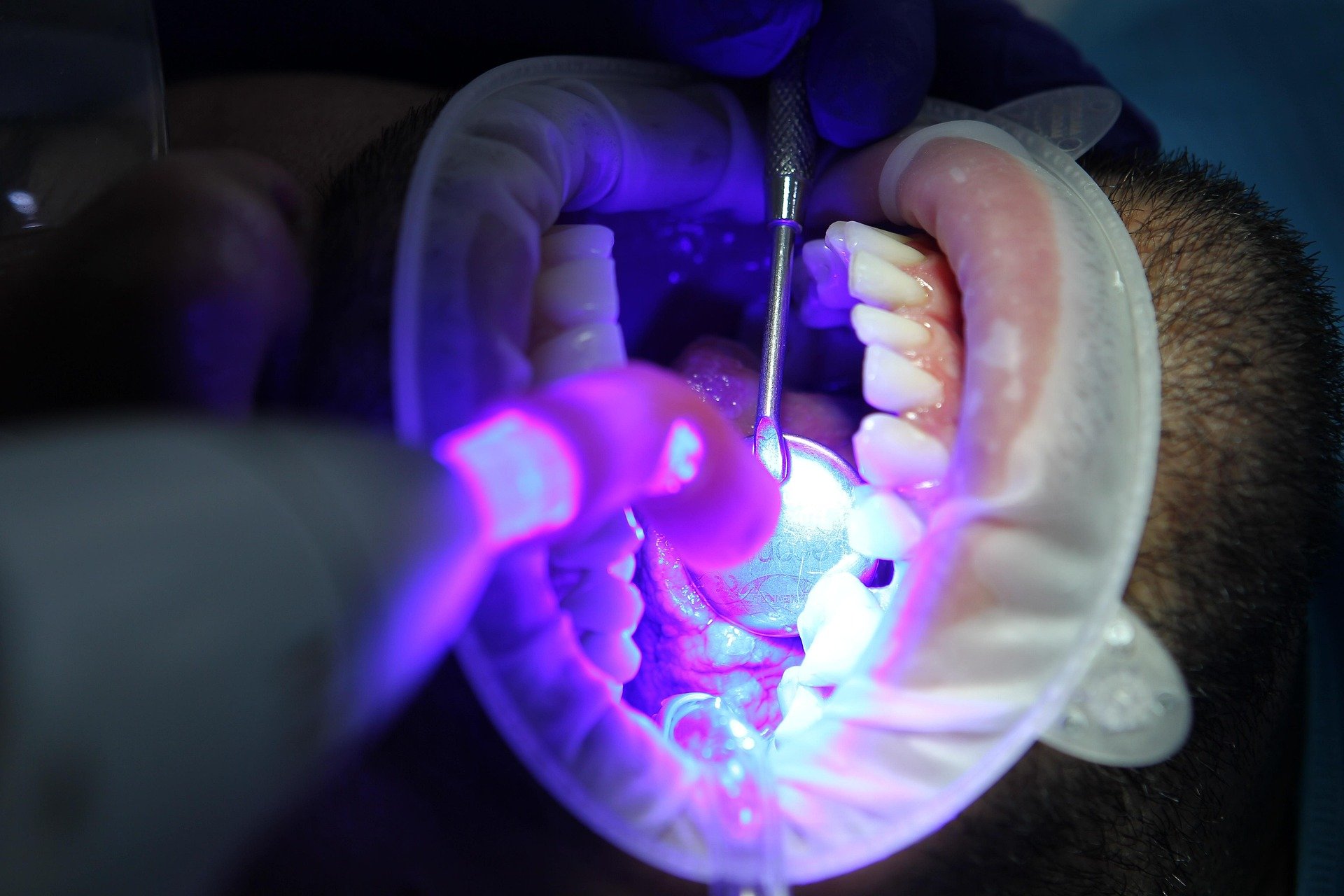 A dentist uses instruments and a curing light inside a patient’s open mouth, which is held open with a dental retractor during an Invisalign procedure that may also include teeth whitening for a brighter smile.