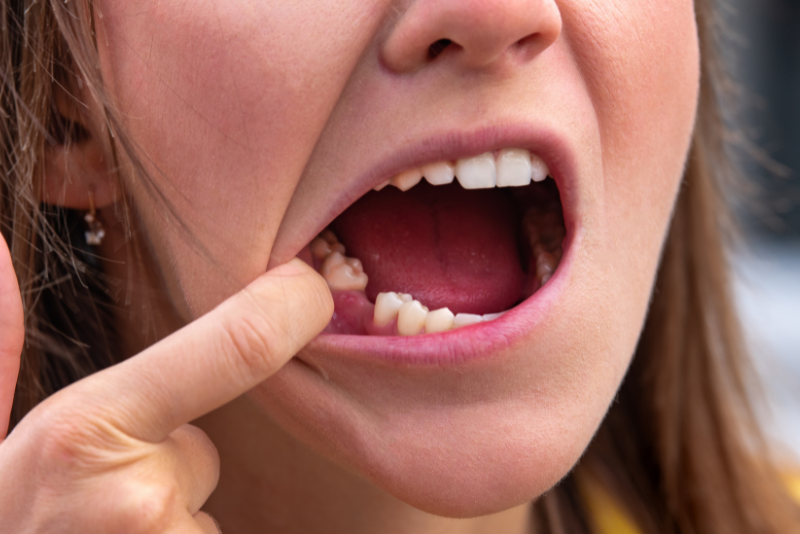 A person uses their finger to point at their lower back teeth with their mouth open wide, clearly showing their teeth and gums—possibly highlighting a missing tooth or an area needing orthodontic treatment.