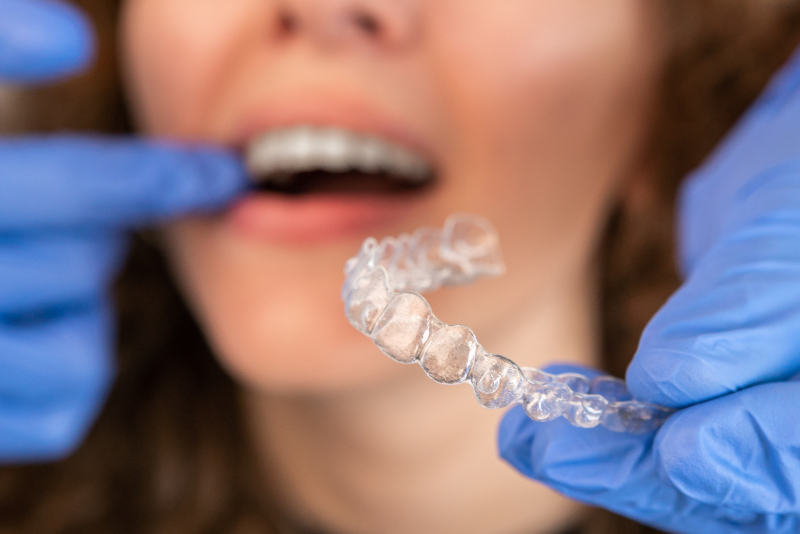 A person with curly hair is about to wear a clear Invisalign dental aligner, while a gloved hand holds another aligner in the foreground. The scene suggests orthodontic care or dental treatment, possibly to fix an overbite.