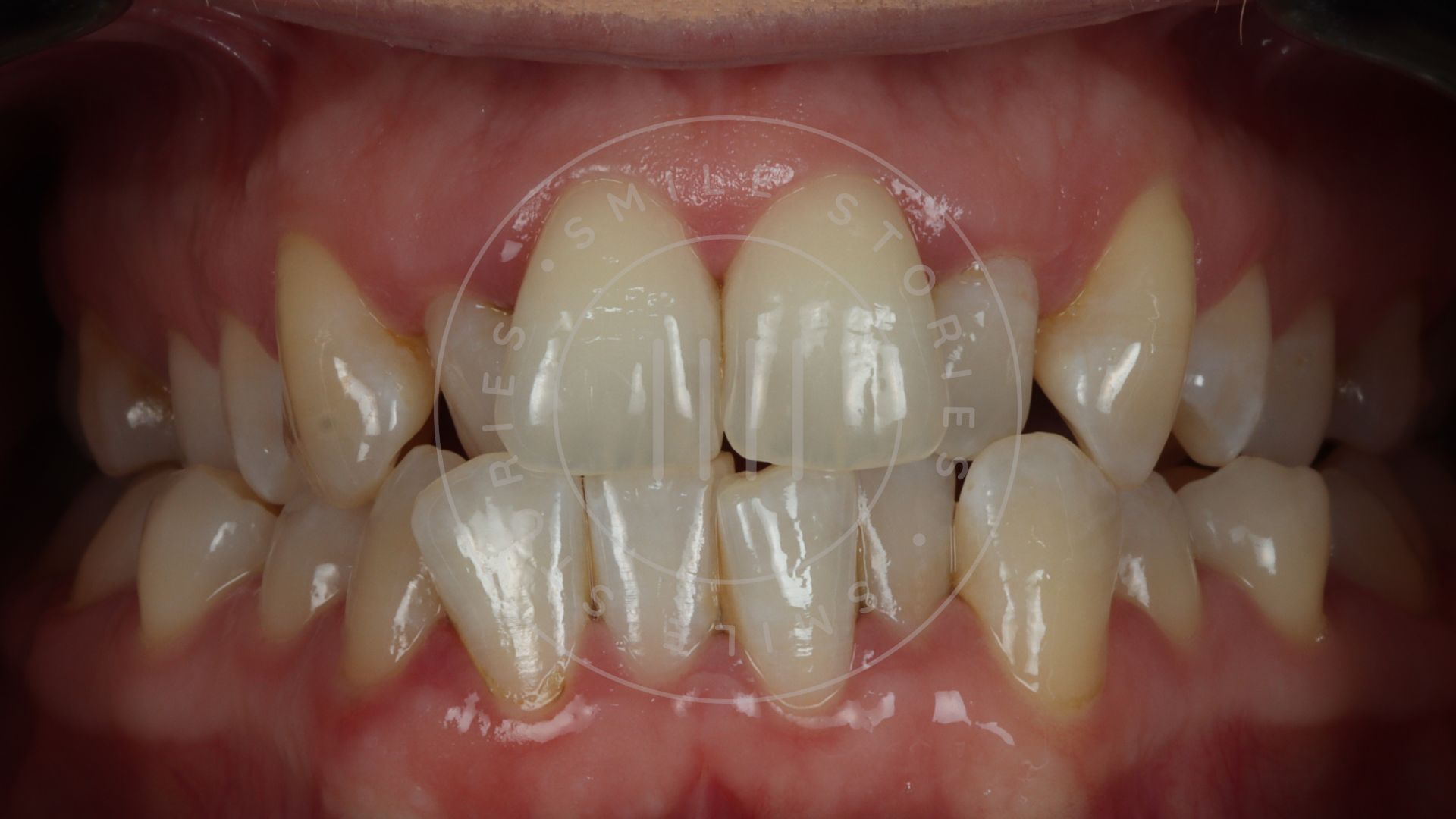Close-up of a person's teeth showing misalignment and crowding, with visible overlapping and irregular positioning of upper and lower teeth. Gums are visible and healthy in colour, raising the question: can Invisalign fix crossbite in cases with such dental crowding?.