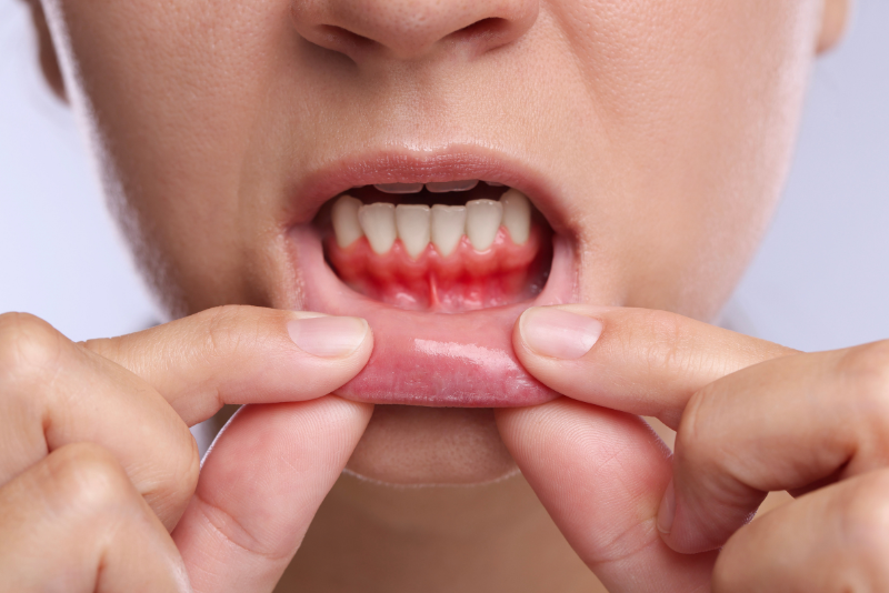 A person pulls down their lower lip to reveal red, inflamed gums and teeth, possibly showing signs of gum recession or irritation.