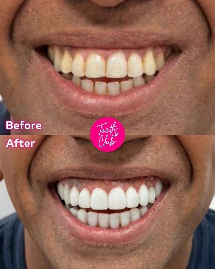 A before and after comparison of a person's smile, showing yellowed, uneven teeth in the top image and bright, white, even teeth in the bottom image. Tooth Club logo is centred between the images.