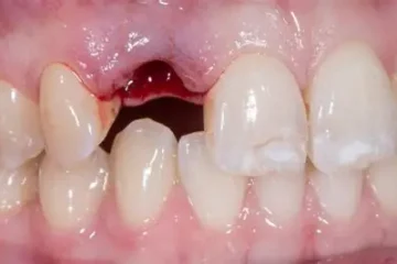 Close-up of a person’s upper front teeth with one tooth missing and a visible gap in the gum, showing some redness and slight bleeding where the tooth was extracted—a clear example of what to do if you knock a tooth out.