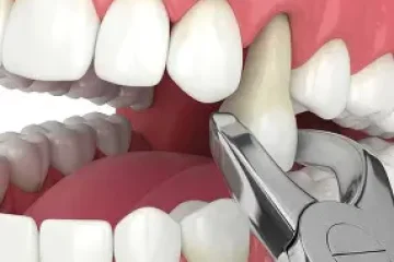 A dental tool is extracting a tooth from the upper jaw in a realistic illustration of a mouth with white teeth and gums, offering a visual insight into the process often associated with discussions about Tooth Extraction Cost UK.