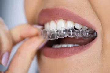 A close-up of a person’s mouth as they place a clear Invisalign aligner over their upper teeth with their hand, demonstrating the precision required during treatments like IPR with Invisalign.